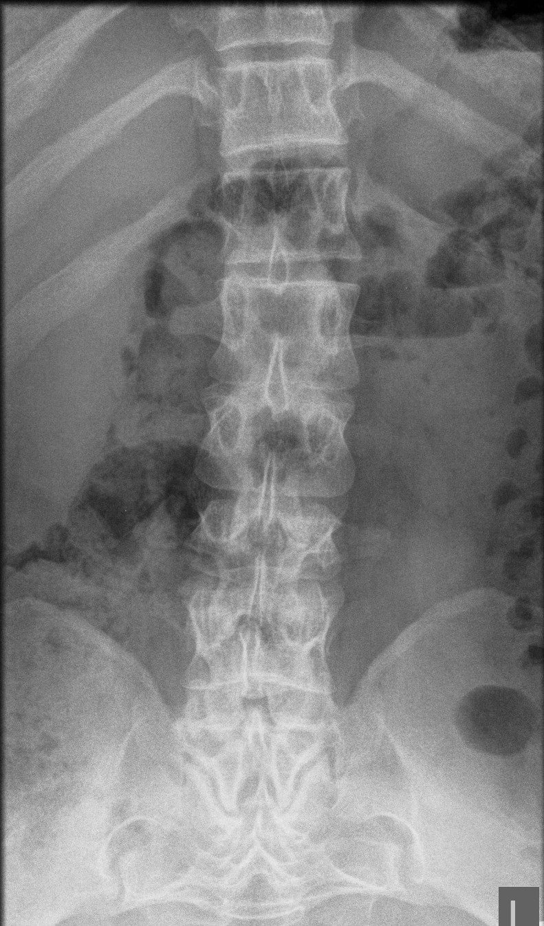 Achondroplasia Decreased Interpedicular Distance